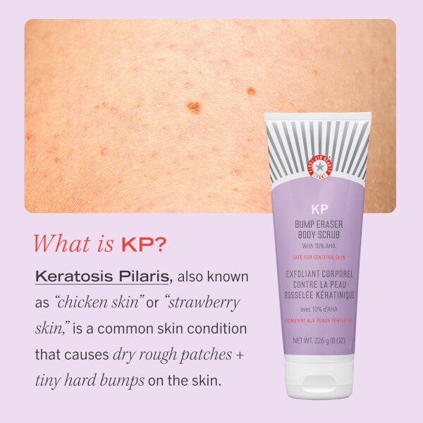 First Aid Beauty KP Bump Eraser Body Scrub with 10% AHA 226g Verkauf