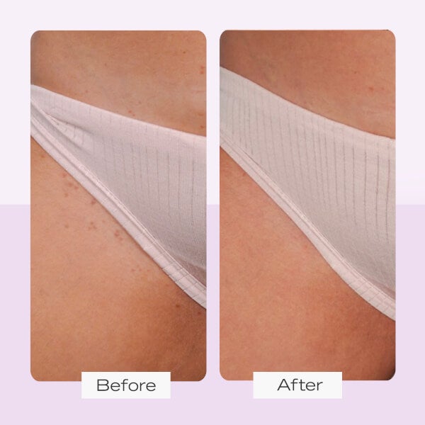 First Aid Beauty Ingrown Hair Treatment Pads (28 Pads) Bis zu 60% Rabatt